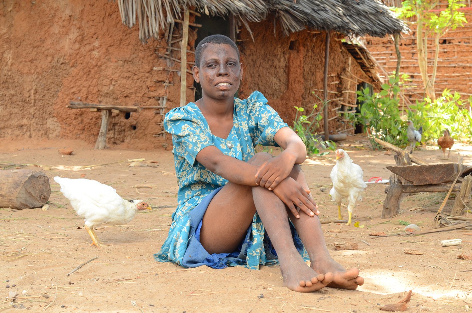 An adolescent girl is seated on the ground surrounded by chickens. Her complexion is affected by burn scars.